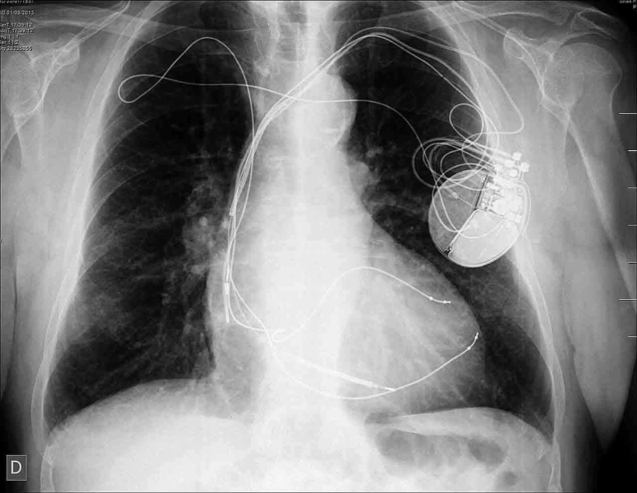 Figura 6. Radiografía posterior al procedimiento de implante de electrodo adicional para estimulación del VI.