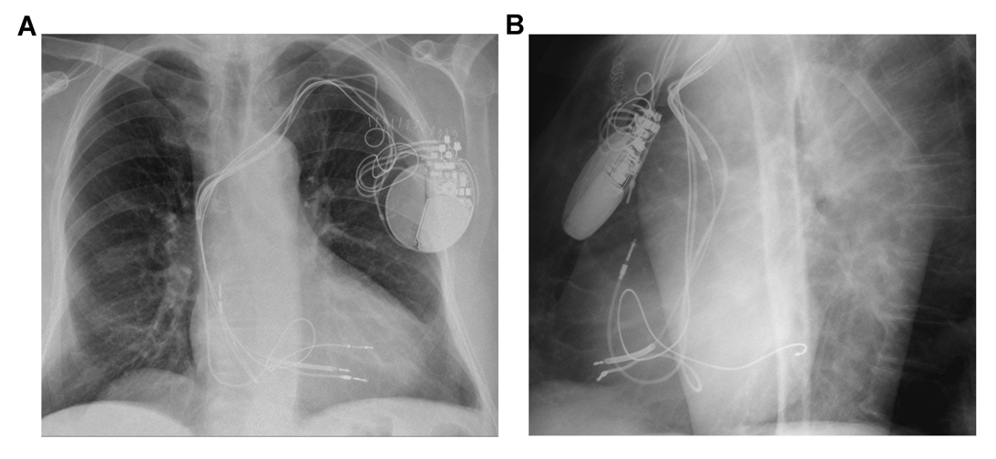 Figura 2. Se implantó un cable de desfibrilación bibobina (Endotak Reliance modelo 0185, Boston Scientific), posicionado en ápex de ventrículo derecho.