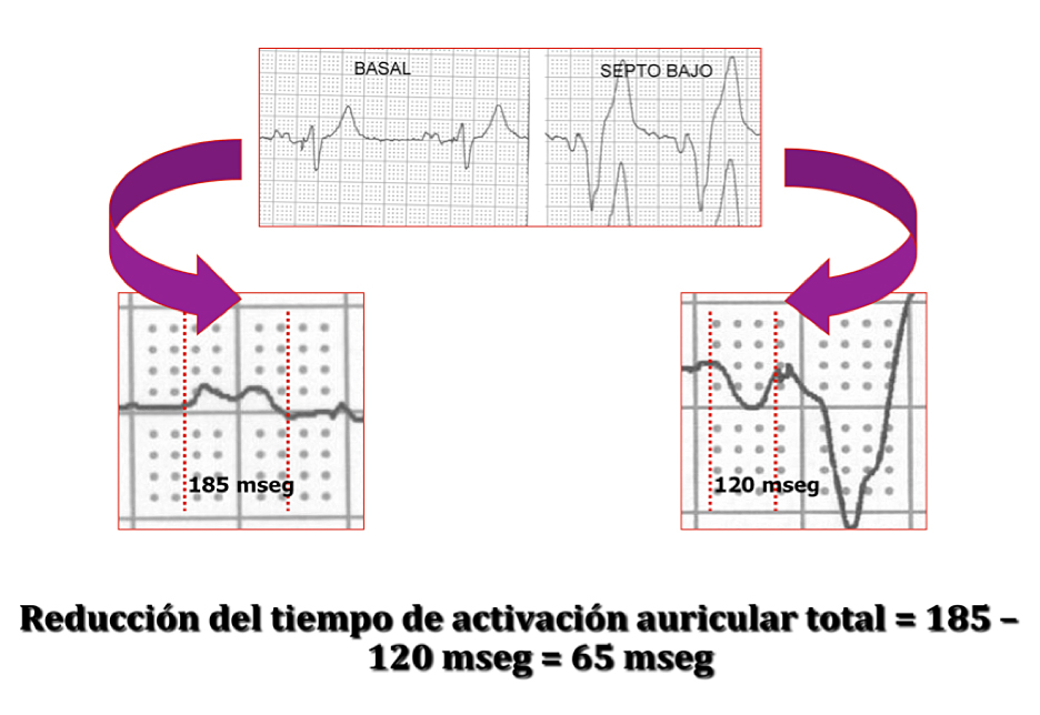 Reducción del tiempo de activación auricular total por estimulación en septo interauricular bajo. Duración de la onda P intrínseca 185 ms. Duración de la onda P estimulada 120 ms. Reducción 65 ms.
