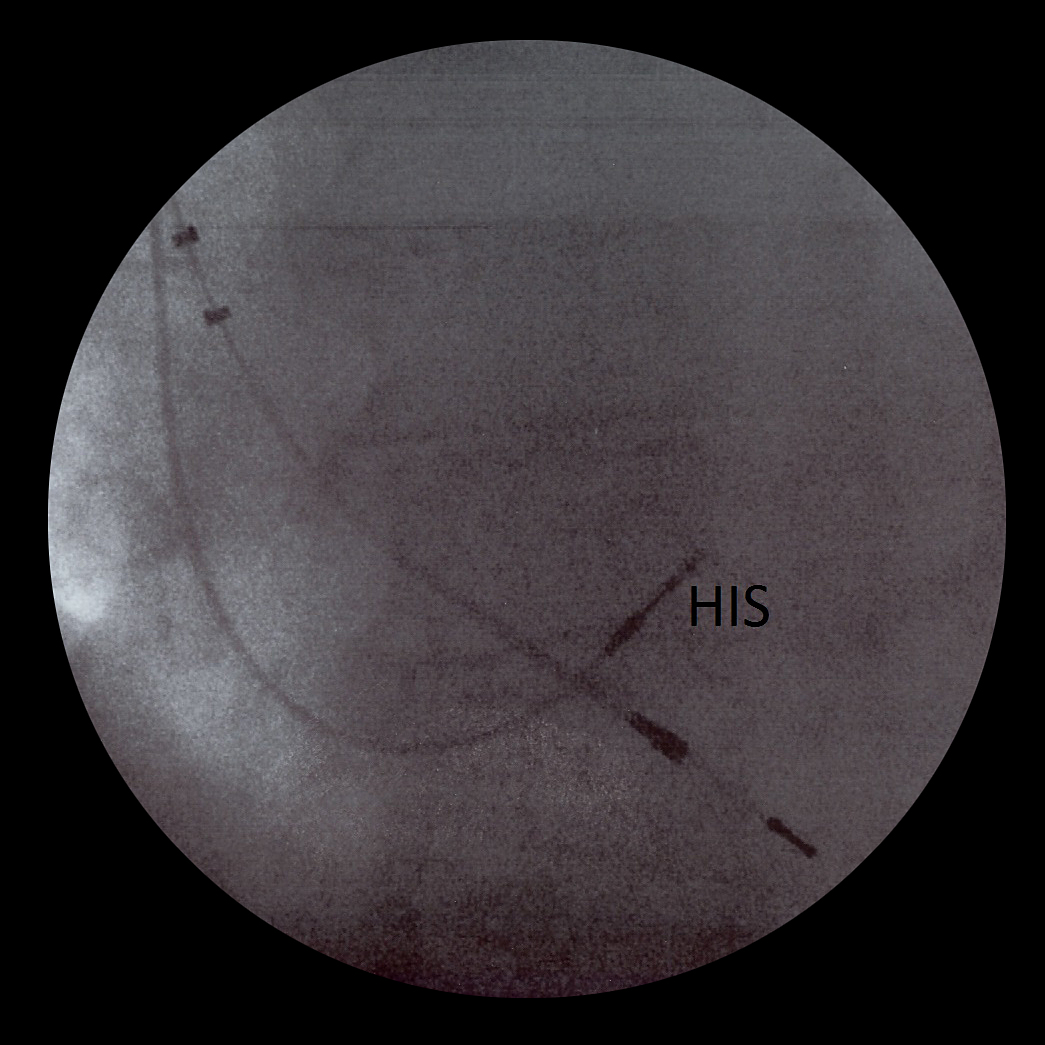 FIGURA 1: Imagen PA obtenida en el momento de implante. Se objetiva el cable bipolar implantado en His, y el antiguo cable para la estimulación VDD.