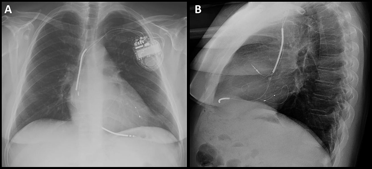 FIGURA 2: Radiografías de tórax post-implante. Proyecciones PA (izquierda) y lateral (derecha), mostrando la posición septoapical del electrodo de VD y lateral media del electrodo de VI.