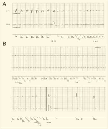 Figura1: Prueba de desfibrilación: el panel A muestra la inducción de fibrilación ventricular mediante choque sobre la onda T. El panel B muestra la detección correcta de la arritmia y el tratamiento con descarga única.