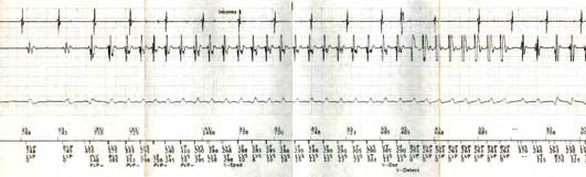 Figura 1. Electrogramas intracavitarios mostrando el inicio de uno de los episodios de taquicardia ventricular sostenida.