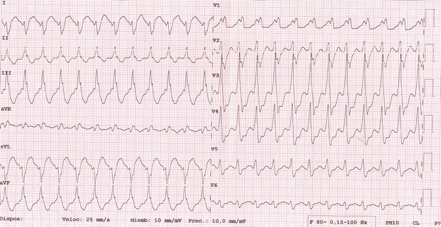Figura 4: ECG de superficie de 12 derivaciones del episodio de taquicardia ventricular.